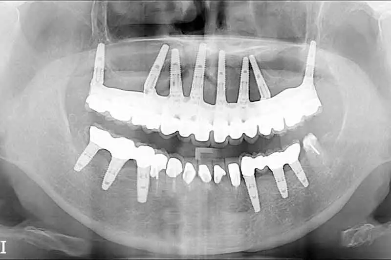 インプラントのレントゲン