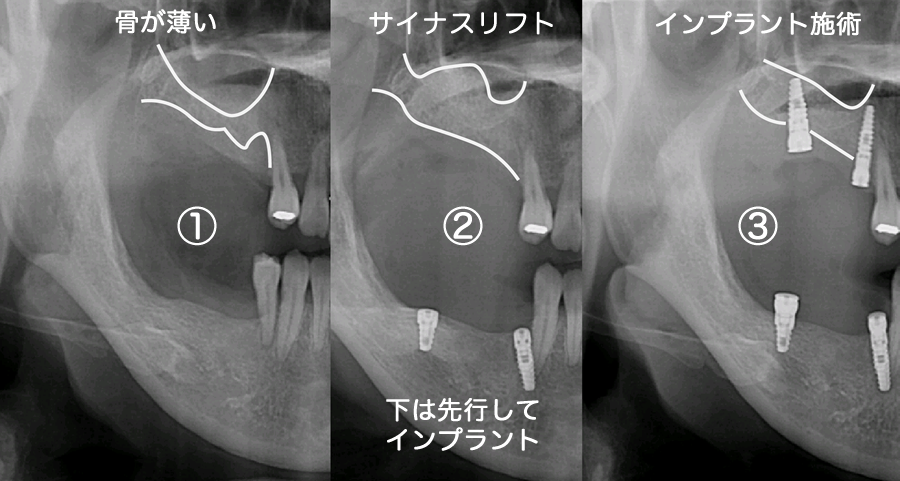 パノラマレントゲン・治療例写真
