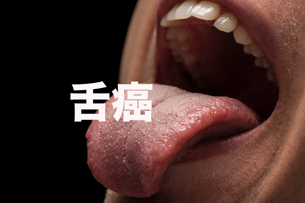 舌がんの原因と症状 坂井歯科医院ブログ