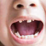 【要注意】乳歯に穴があく原因は虫歯だけじゃない！症状別の対処法を詳しく解説！