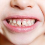 【永久歯がガタガタ】生え始めに気づいたら知っておきたいこと16選｜矯正が必要なサインとは？