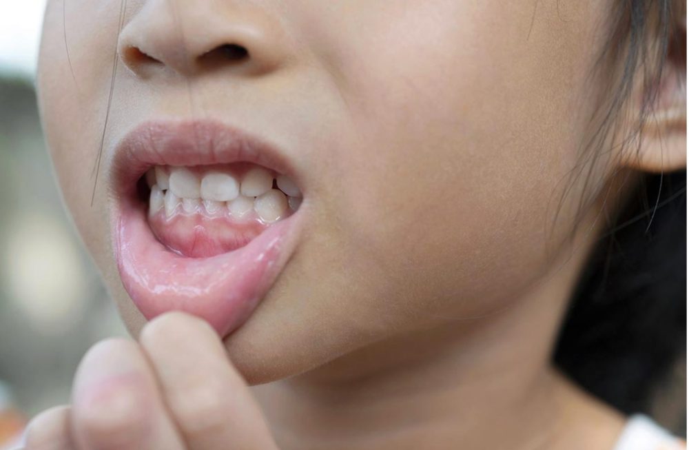 虫歯になりにくいおやつ