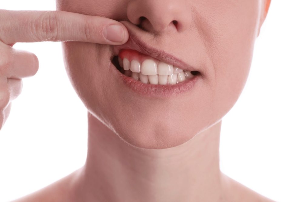 歯茎から血が出る5つの原因｜受診する6つの目安や対処法も徹底解説