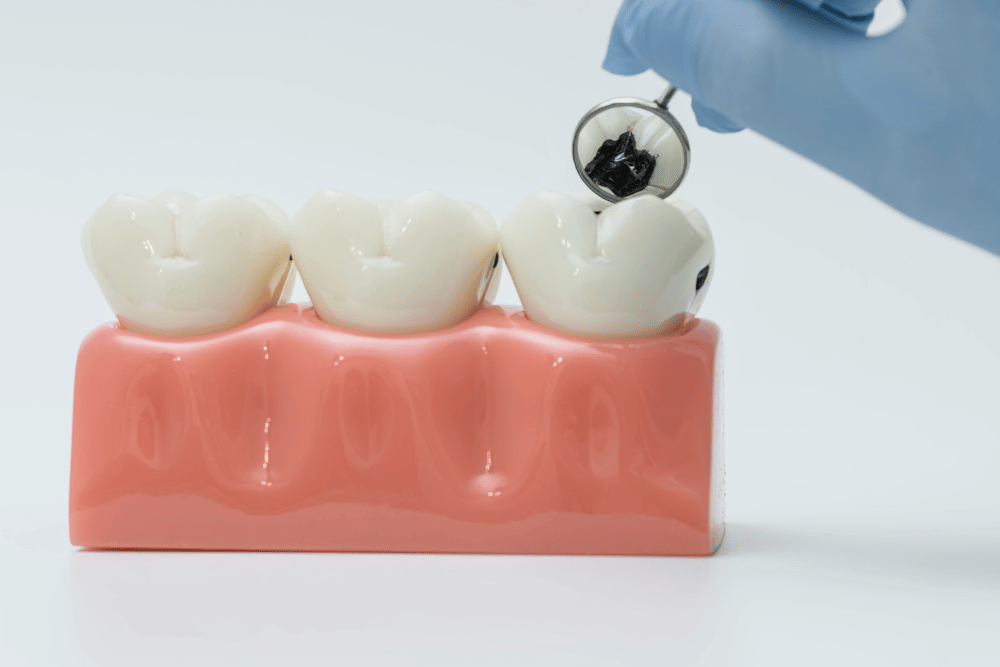 歯と歯の間にできる虫歯は目で見えない