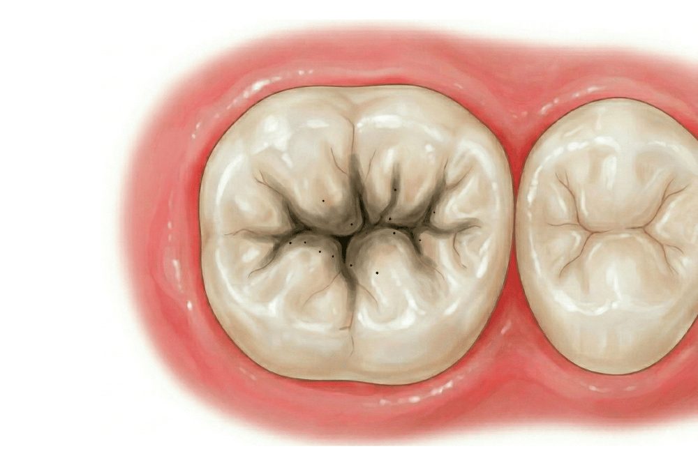 黒い点や黒い線がある虫歯が進行しているサイン
