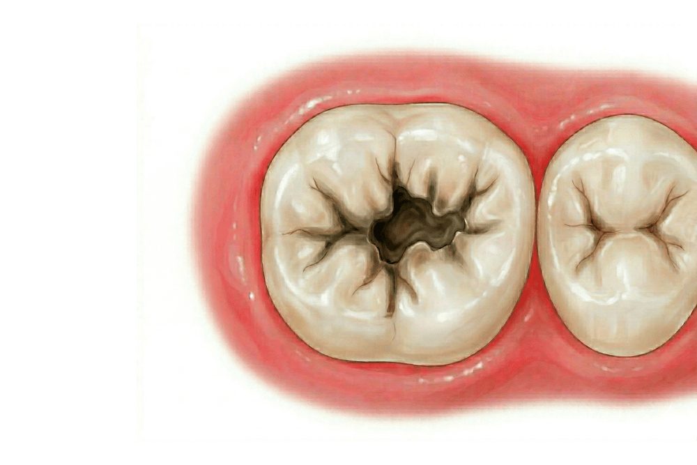 穴が開いている歯が欠けている確実に虫歯が進行している状態