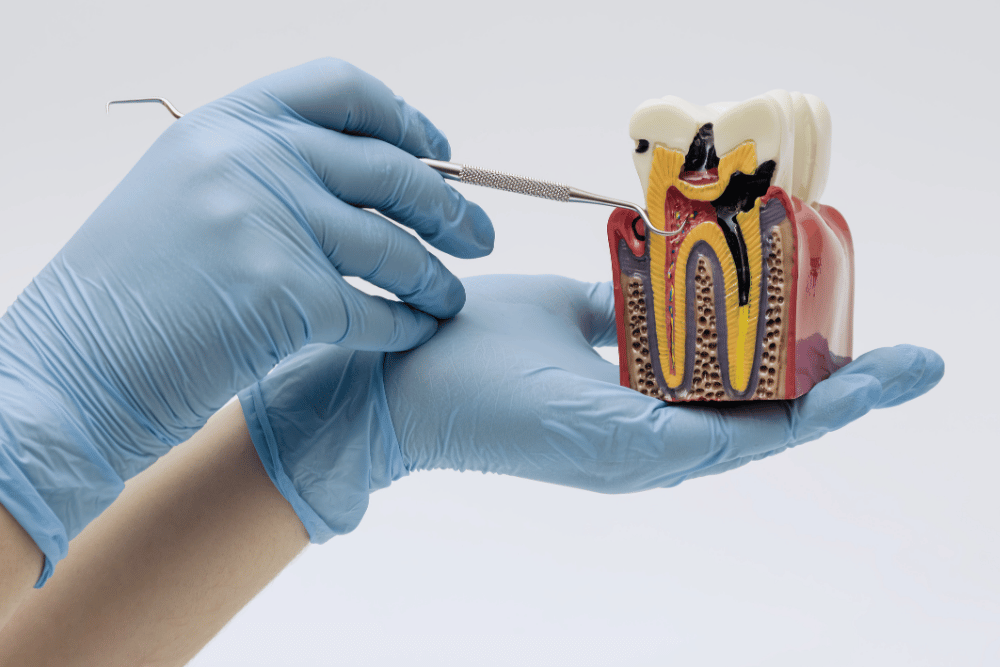 神経まで達した虫歯は根管治療が必要になる