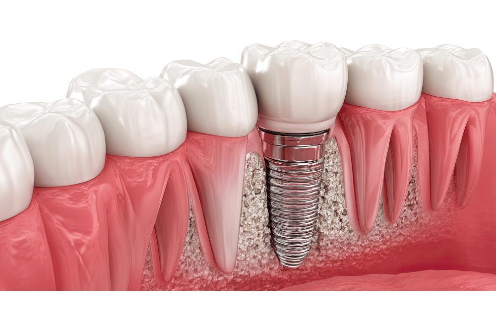 歯を失った場合は入れ歯ブリッジインプラントで補う