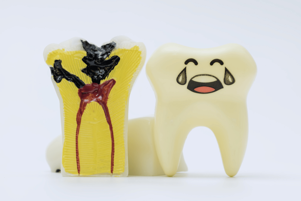 虫歯を放置するとどうなる？進行段階別に解説