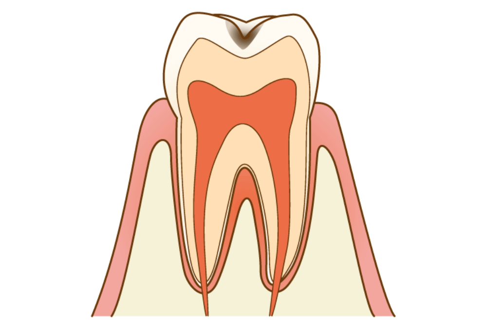 C1 エナメル質の虫歯は痛みがほとんどない