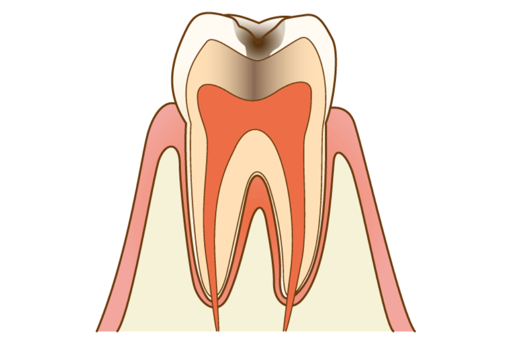 C2 象牙質の虫歯は冷たいものがしみ始める