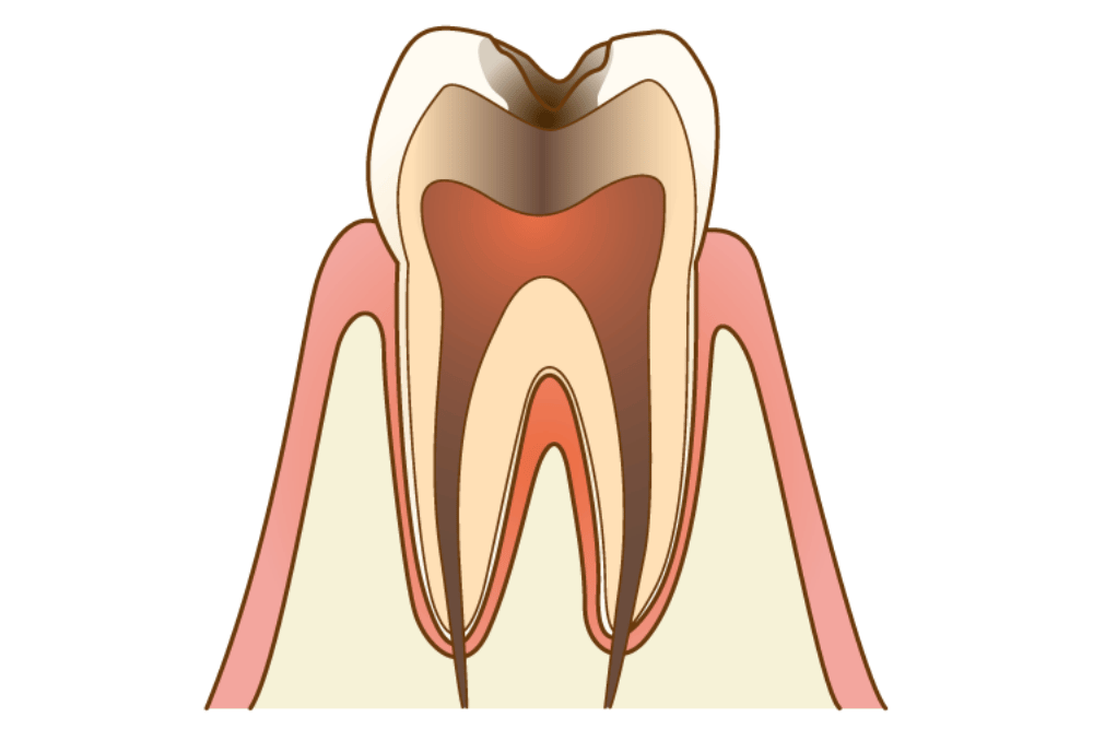 C3 神経まで達した虫歯は激しい痛みが出る