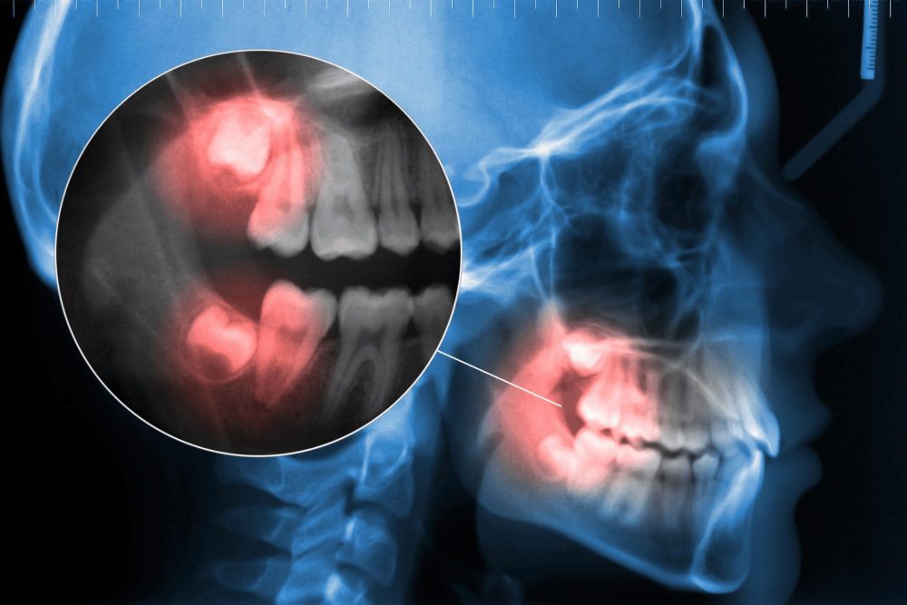 完全に骨の中に埋まっている
