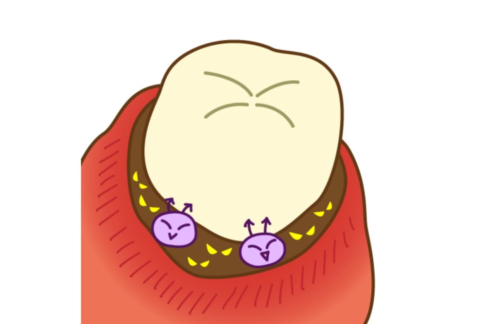 歯周病菌が発生させるガス