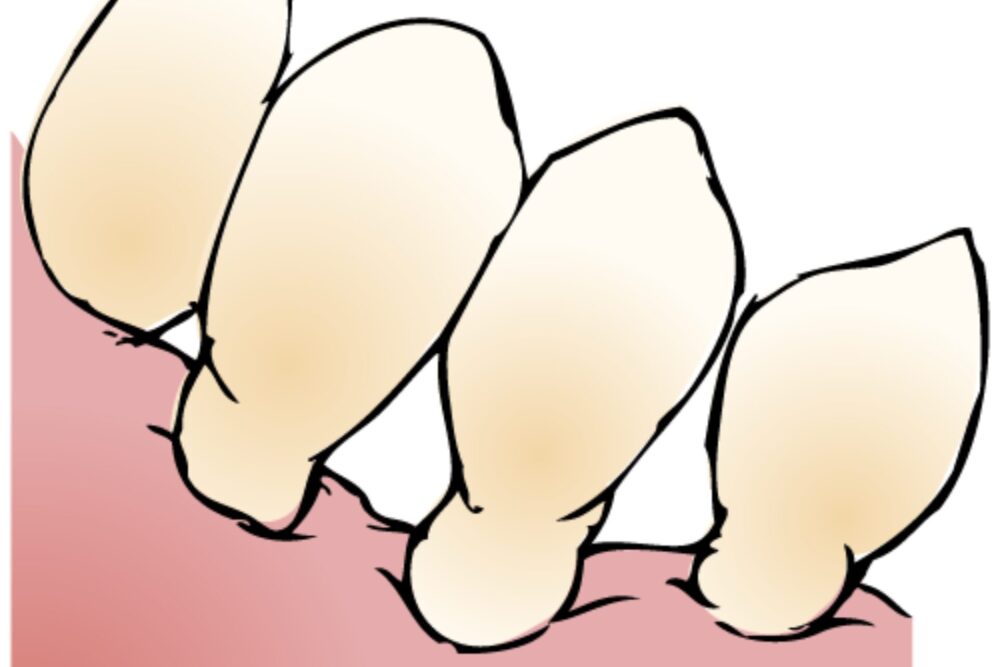 歯周病が原因の歯槽膿漏