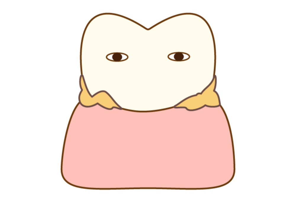 歯垢がたまっている